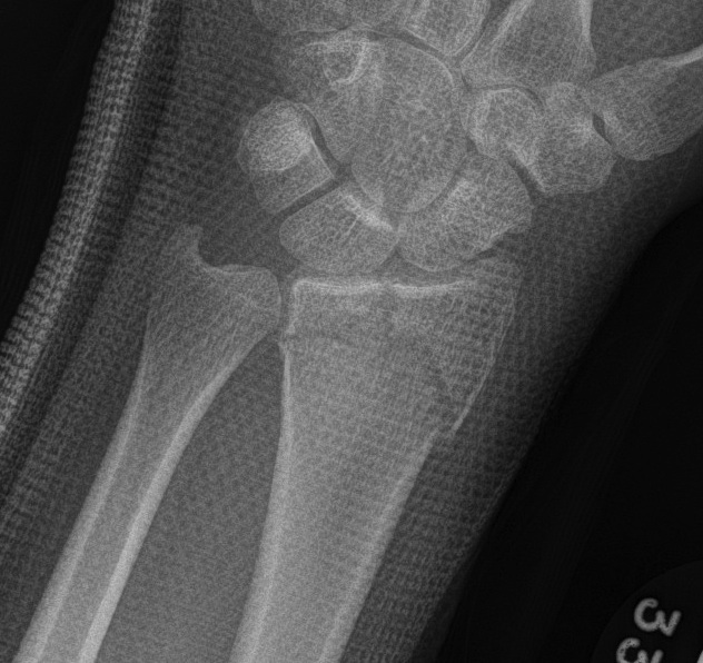 Distal Radius Fracture Undisplaced Intraarticular